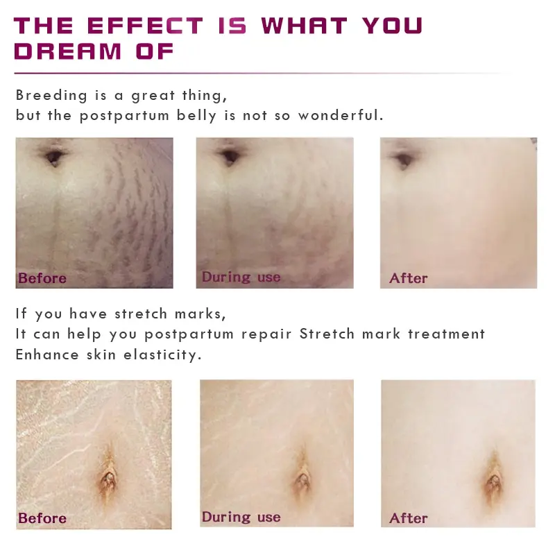 RtopR удаляет шрамы для беременности крем от акне лечение восстановление