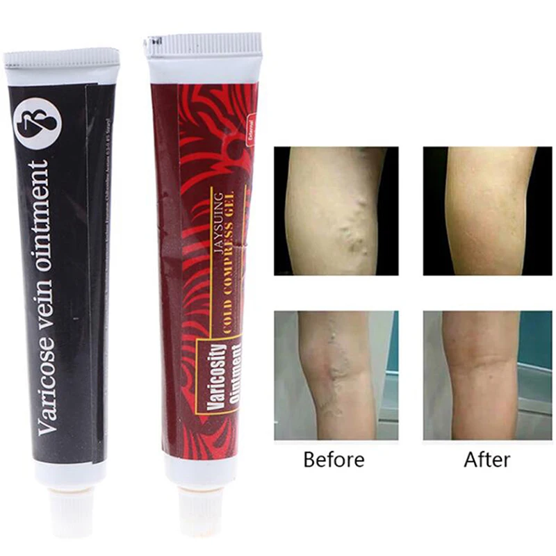 

1Pcs Effective Cure Vasculitis Phlebitis Spider Veins Pain Varicosity Angiitis Ointment Varicose Veins Miracle Cream Treatment