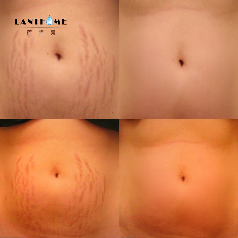 100% Австралийское био масло 200 мл уход за кожей беременность средство для удаления