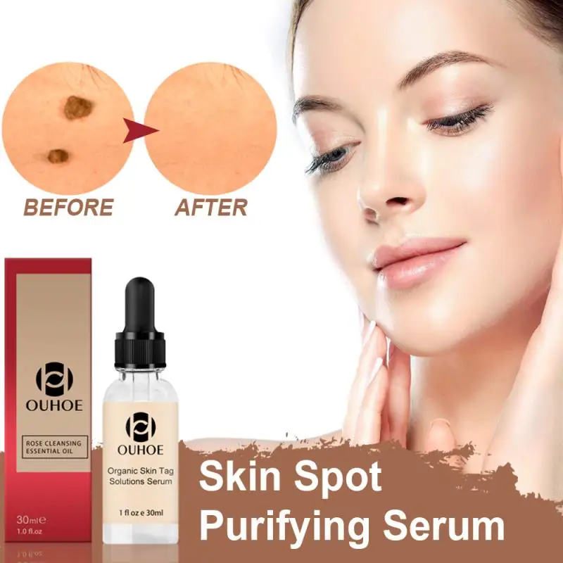 

Organic Tags Solutions Serum Skin Tag Remover Serum No Trace Mole Removal Cream Painless Face Wart Mole Freckle 30ml