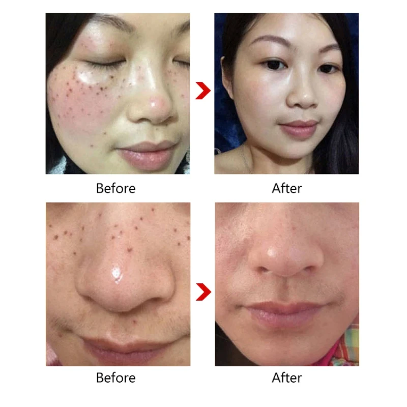Rose Essential Oil Nourishing Skin Removing Nevus Freckles Facial Lighten Whitening Face Serum | Красота и здоровье
