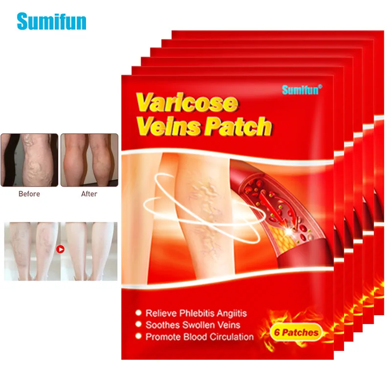 Sumifun 6Pcs Varicose Veins Plaster Treatment Angiitis Spider Leg Vasculitis Phlebitis Care Removal Patch Chinese Herbal Patches | Красота и