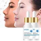 15 мл, так же увлажняет кожу гладкой лицевой стороной Сыворотки лечение от прыщей, отбеливание Суть в черный горошек для маленьких девочек крем удаляющий Шрамы Акне, сокращает поры, кожа в точку, ремонт