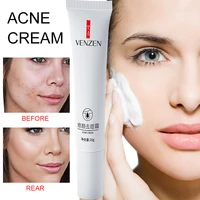 anti acne cream acne treatment anti pimples spot acne scars blackhead removal cream whitening cream beauty skin face care