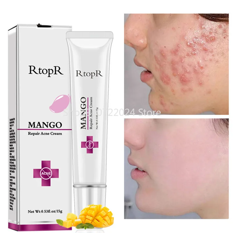

RtopR Acne Treatment Face Cream Moisturizer Against Face Acne Scar Removal Cream Anti Acne Oil Deep Cleansing For Face Care 15g