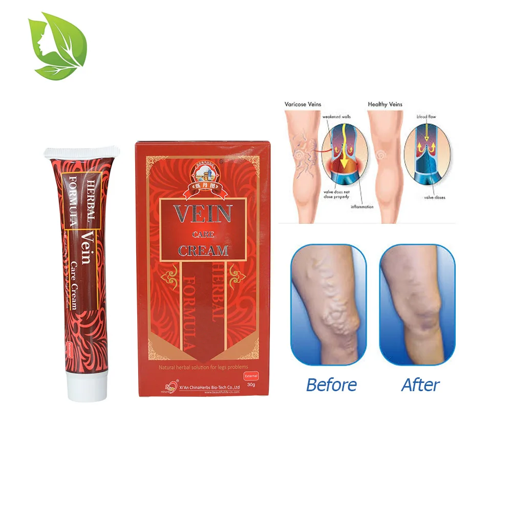 

2 packs vasculitis ointment old bad leg earthworm lumps cream varicose vein plaster spider veins leg swelling ointment