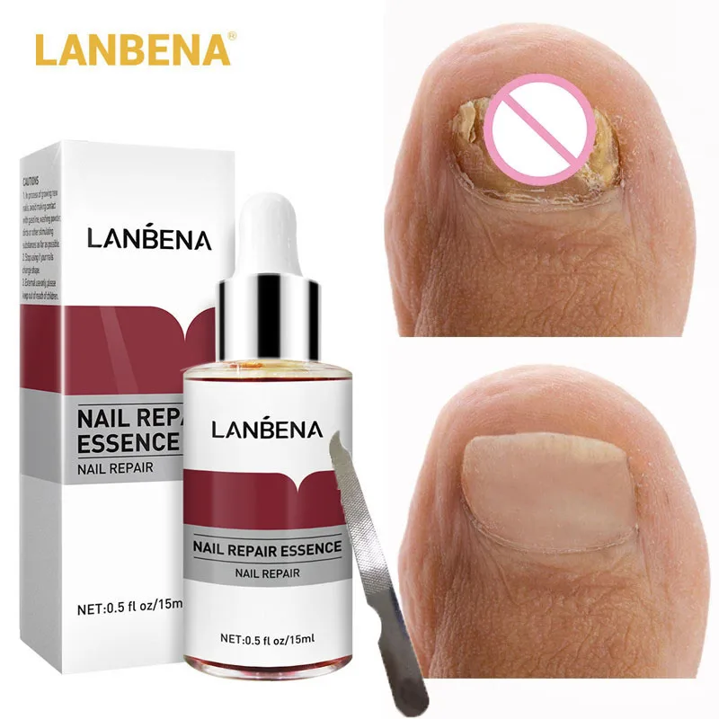 

LANBENA Fungus Nail Serum Fungal Toe Nail Repair Essence Treatment Repair Onychomycosis Soften Brighten Hand Foot Nail Care 12ml