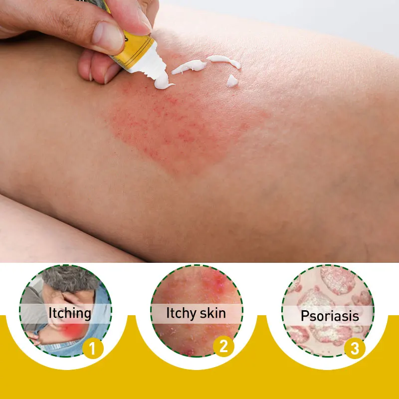 Мазь Тигровая для псориаза дерматита антибактериальная мазь снятия симптомов