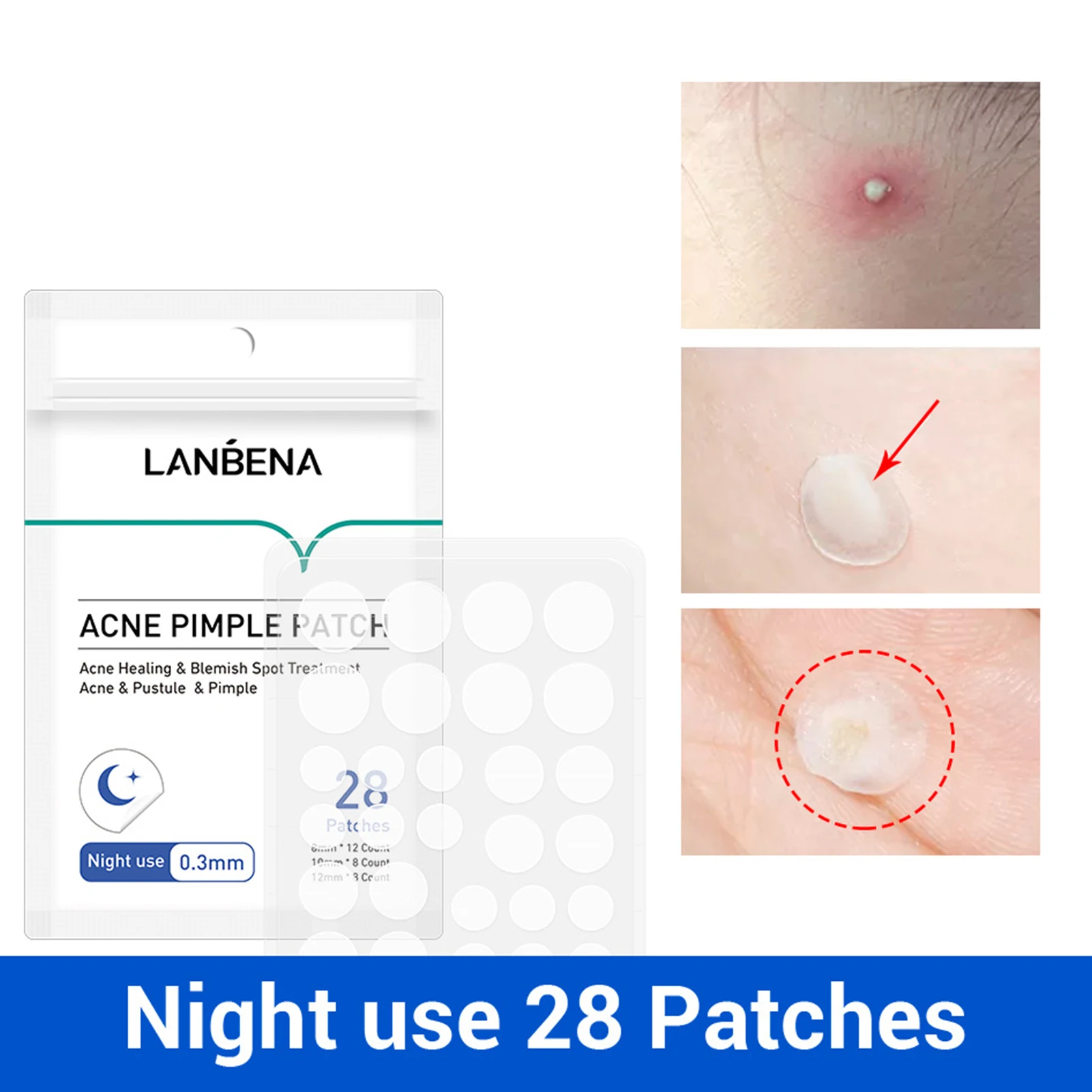 LANBENA Mild Skin Care Treatment Waterproof Night Use Acne Pimple Remover Patch