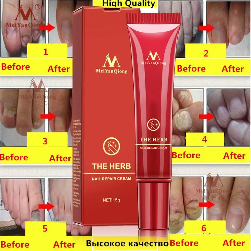 

Meiyanqiong Nail Care Herbal Nail Repair Cream Anti Fungal Nail Chinese Herbal Toe Nail Fungus Treatment