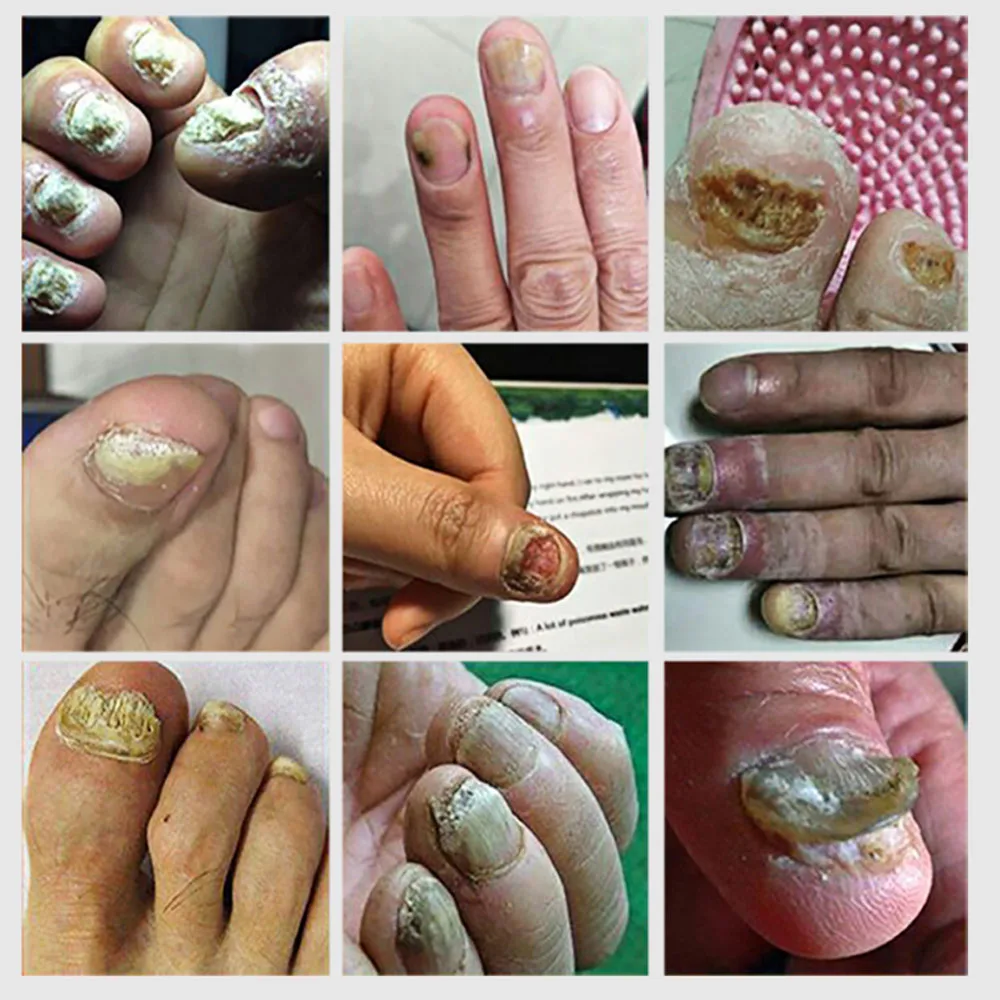 

LANBENA Nail Fungus Removal Cream Onychomycosis Fungal Nail Care Gel Paronychia Anti Infection Feet Toe Hand And Foot Care