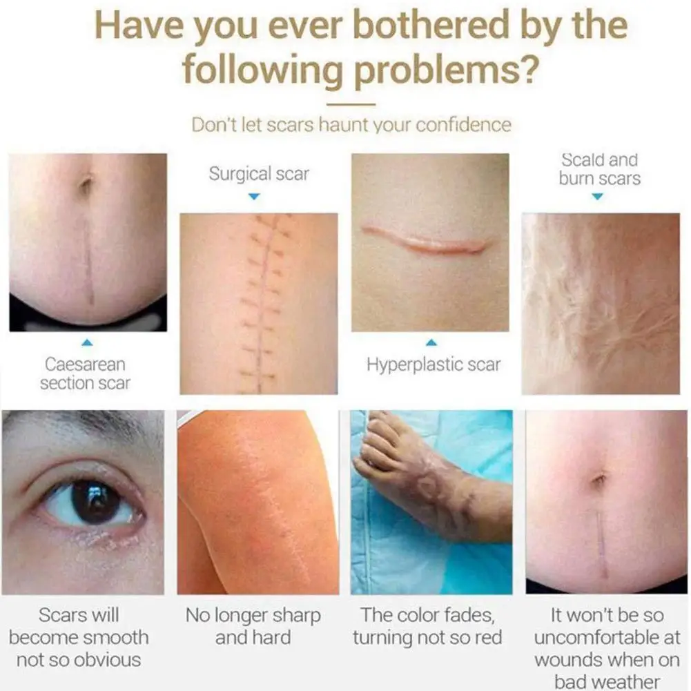 

Acne Scar Removal Cream Pimples Stretch Marks Face Smoothing Acne Gel Skin Moisturizing Body Antibacterial Remove Care Whit N6U5