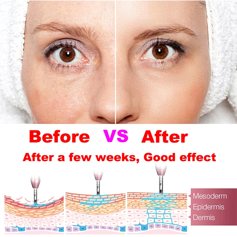 Неинвазивный небулайзер одноразовые 0 3 мл шприц ампулы головка иглы для