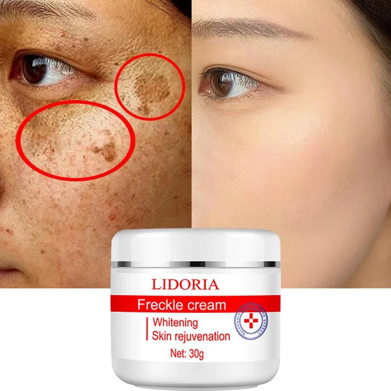 Whitening Freckle Cream Fade Dark Spots Remove Melasma Melanin Pigmentation Remover Brighten Skin Anti-Aging Skin Lightening 30g