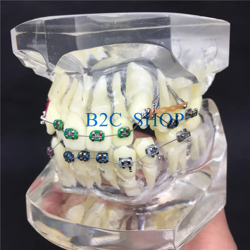 Стоматологическая Ортодонтическая модель с красочными кронштейнами для