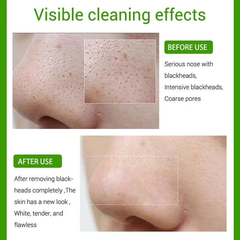 

Blackhead Removal Essence Acne Pimple Treatment Shrink Pores Purifying Skin Care ZGOOD