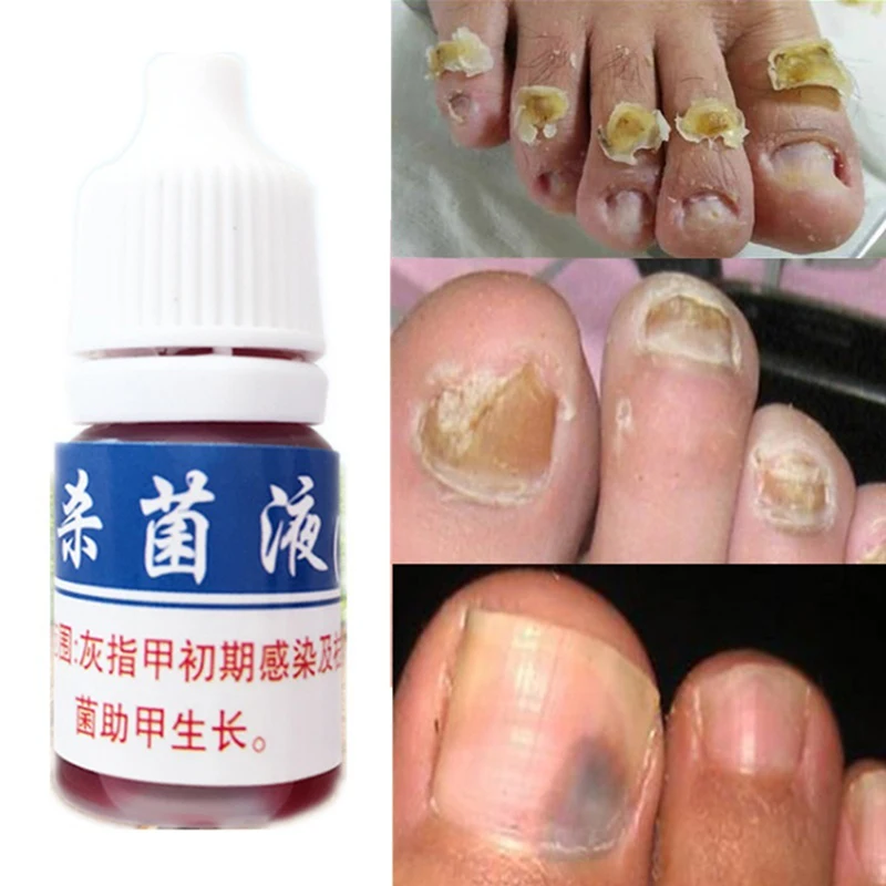 

Anti Infection Fungal Nail Treatment Liquid Foot Care Essence Whitening Toe Nail Fungus Removal Gel Paronychia Onychomycosis