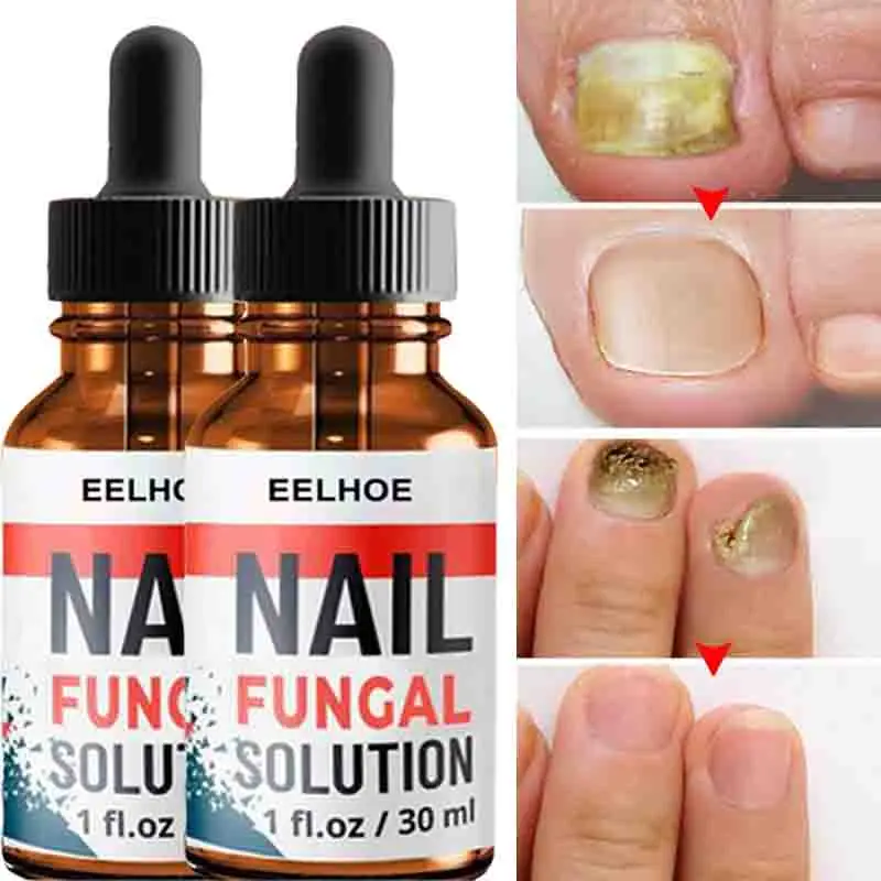 Сыворотка для восстановления ногтей сыворотка лечения грибков онихомикоз