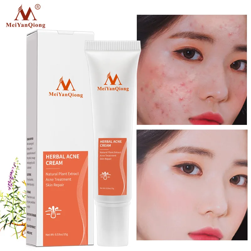 

Effective Acne Removal Cream Herbal Anti-acne Repair Fade Acne Spots Oil Control Whitening Moisturizing Face Gel Skin Care 15g