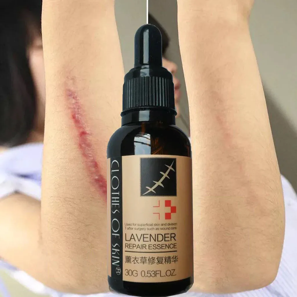 

Go Scar Removal Gel For Keloids, Burn, Sports Injuries Scar Acne 30g Lavender Repair Essence