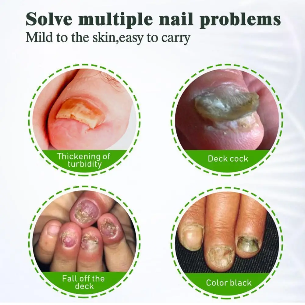 

1pcs Nail Fungus Treatment Cream Removal Nail Paronychia Plaster Whitening Toe Care Onychomycosis Ointment Feet N2B6