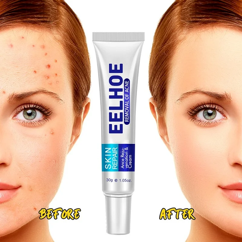 

Effective Acne Removal Cream Acne Treatment Fade Acne Spots Oil Control Anti-Acne Shrink Pores Whiten Face Gel Skin Care