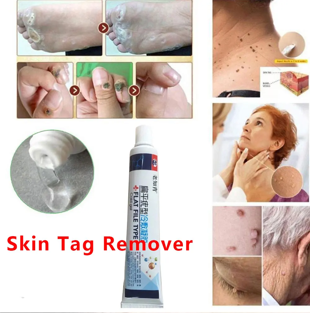 Удаление бородавок на коже удаление жидкости с кожи моли|Устройство для ухода за