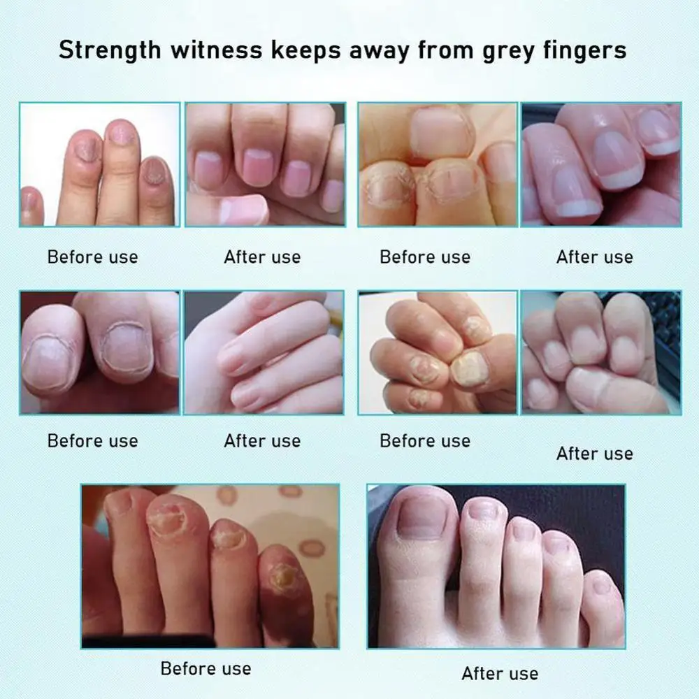 Противогрибковый набор для домашнего лечения ручка Ногтей онихомикоз пароникья