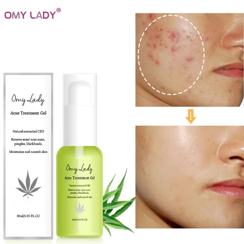 Гель для лечения акне OMY LADY Сыворотка от прыщей лицо со шрамом алоэ против
