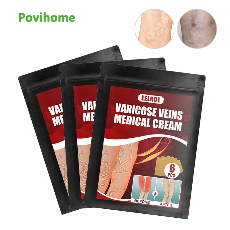 Пластырь для лечения варикозного расширения вен 6 шт./пакет | Красота и здоровье