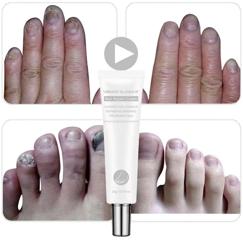 

20ml Nail Repair Cream Onychomycosis Paronychi Nail Repair Fungal Cream Anti Infection Bacteria Treatment Nail Tool Nail Fi N8Y9