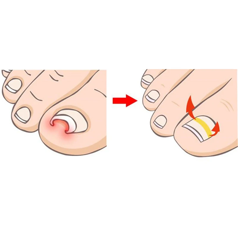 Новинка 10 стикер для коррекции вросших ногтей патч паронихии средство ухода за