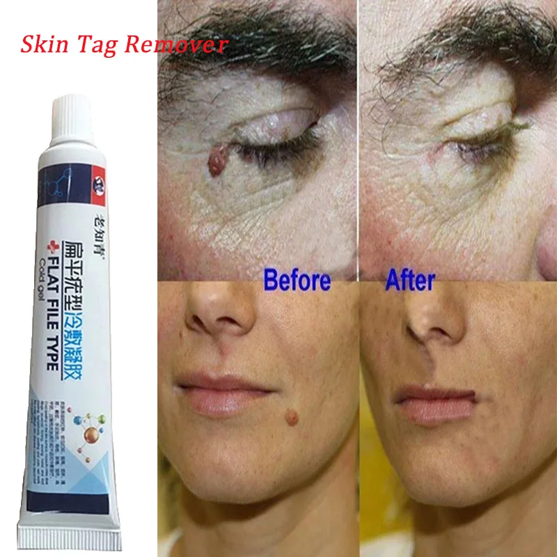 Удаление бородавок на коже удаление жидкости с кожи моли|Устройство для ухода за