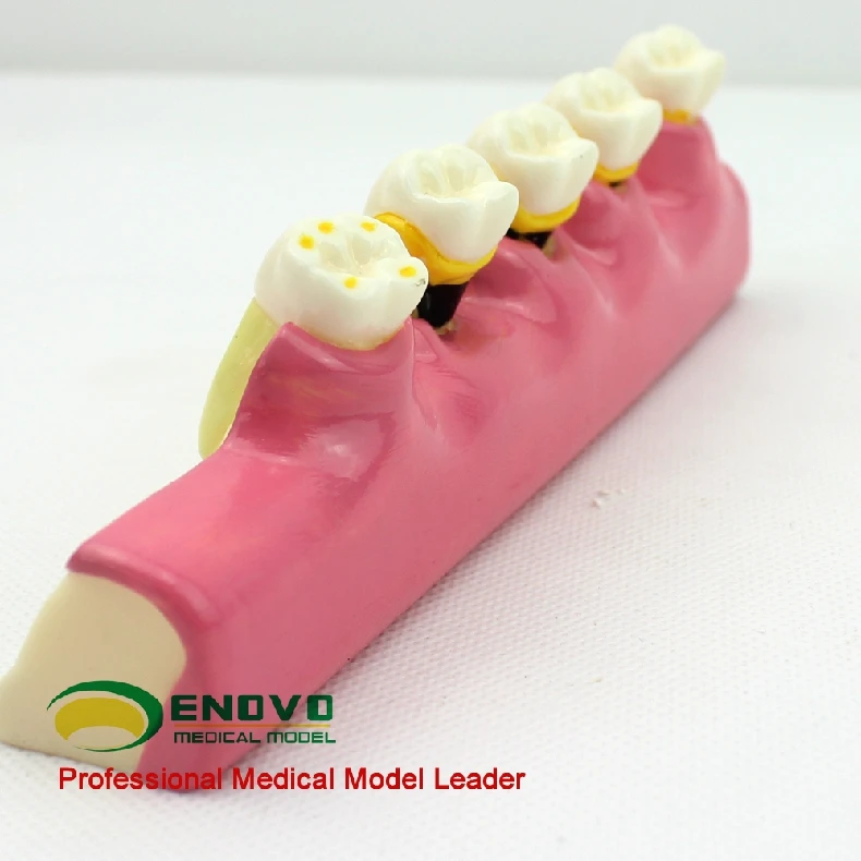 Classification model of oral periodontal disease