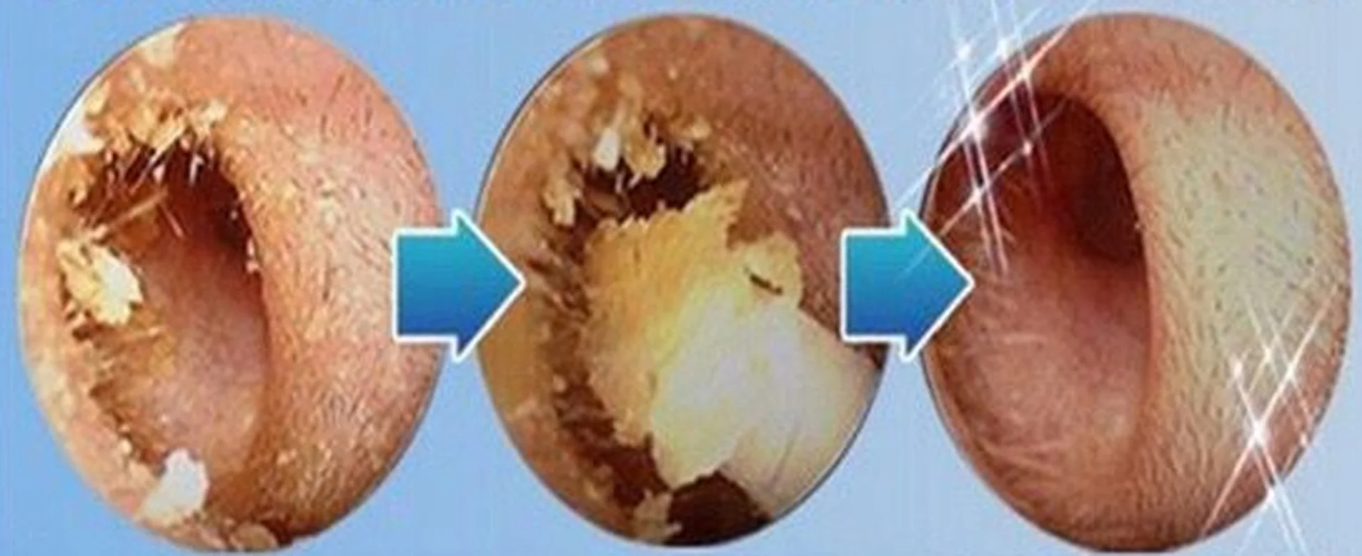 Синий Удобный беспроводной очиститель ушей электрический пылесос для
