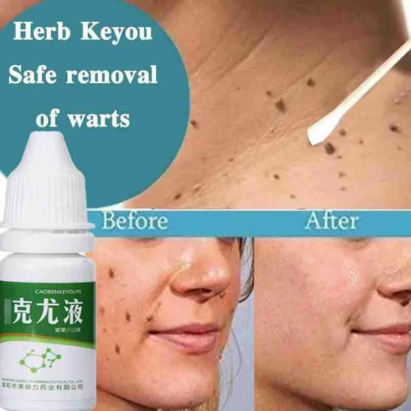 Бирки для кожи средство удаления жидкости кукурузы папилломы Кротов подошвенных