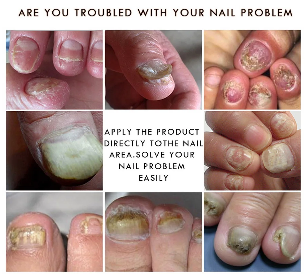 Крем для лечения грибка от паронихии и онихомикоза 100% 10 мл | Красота здоровье