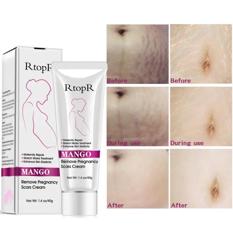 RtopR Remove Pregnancy Scars Acne Repair Scar Removal Cream Gel Stretch Marks Burn cream Body care |