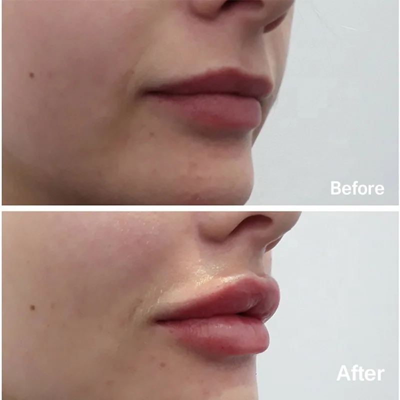 

1~5ML Lip Filler Injections Juvaderm Cross-linked Enlarged Lip Filler Injector Hyaluronic Acid Pen Lip Filling For Hylauron Pen