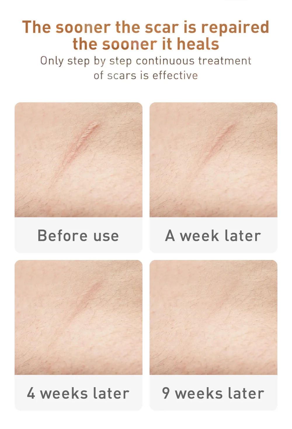 Крем для удаления шрамов от акне 30 мл | Красота и здоровье