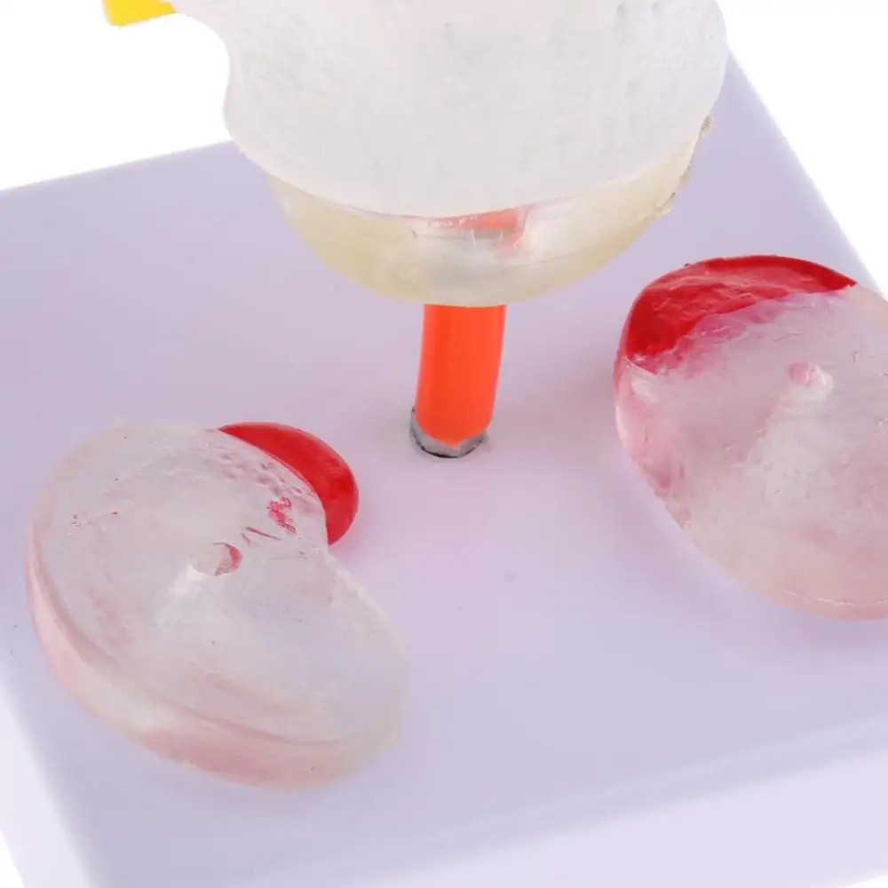 Человеческий 2 Поясничный Позвоночник с больным межпозвонковым диском модель