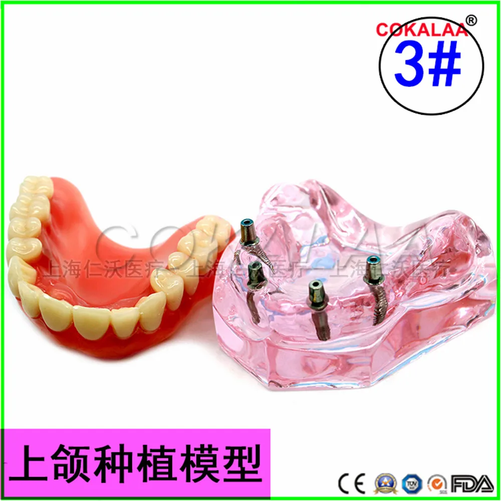 Модель верхней челюсти для зубных имплантатов с зубными протезами хорошего качества для обучения стоматологов.