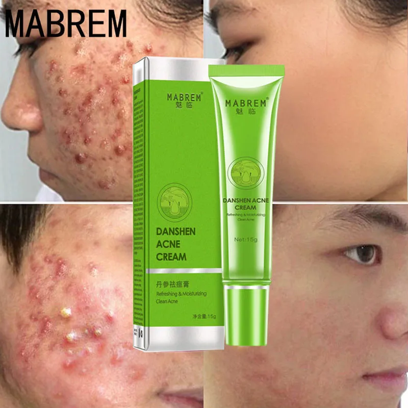 

Effective Acne Removal Cream Acne Treatment Fade Spots Oil Control Shrink Pores Whitening Moisturizing Daily Skin Care Cosmetics