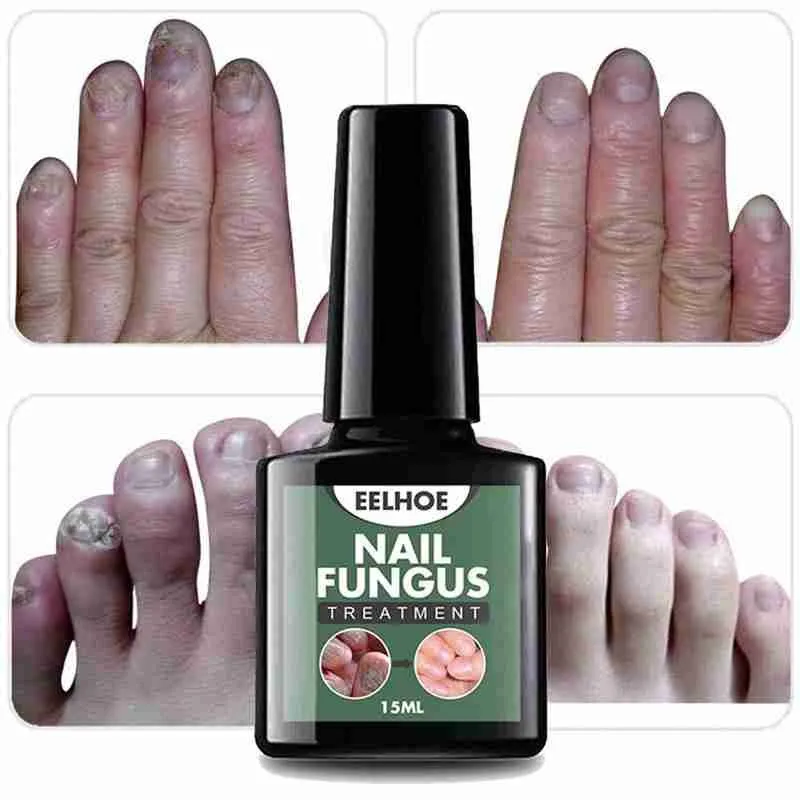

Fungal Nail Treatment Serum Nail Foot Nail Fungus Removal Nail Onychomycosis Repair Fungal Serum Infection Gel Repair Nail J9H0