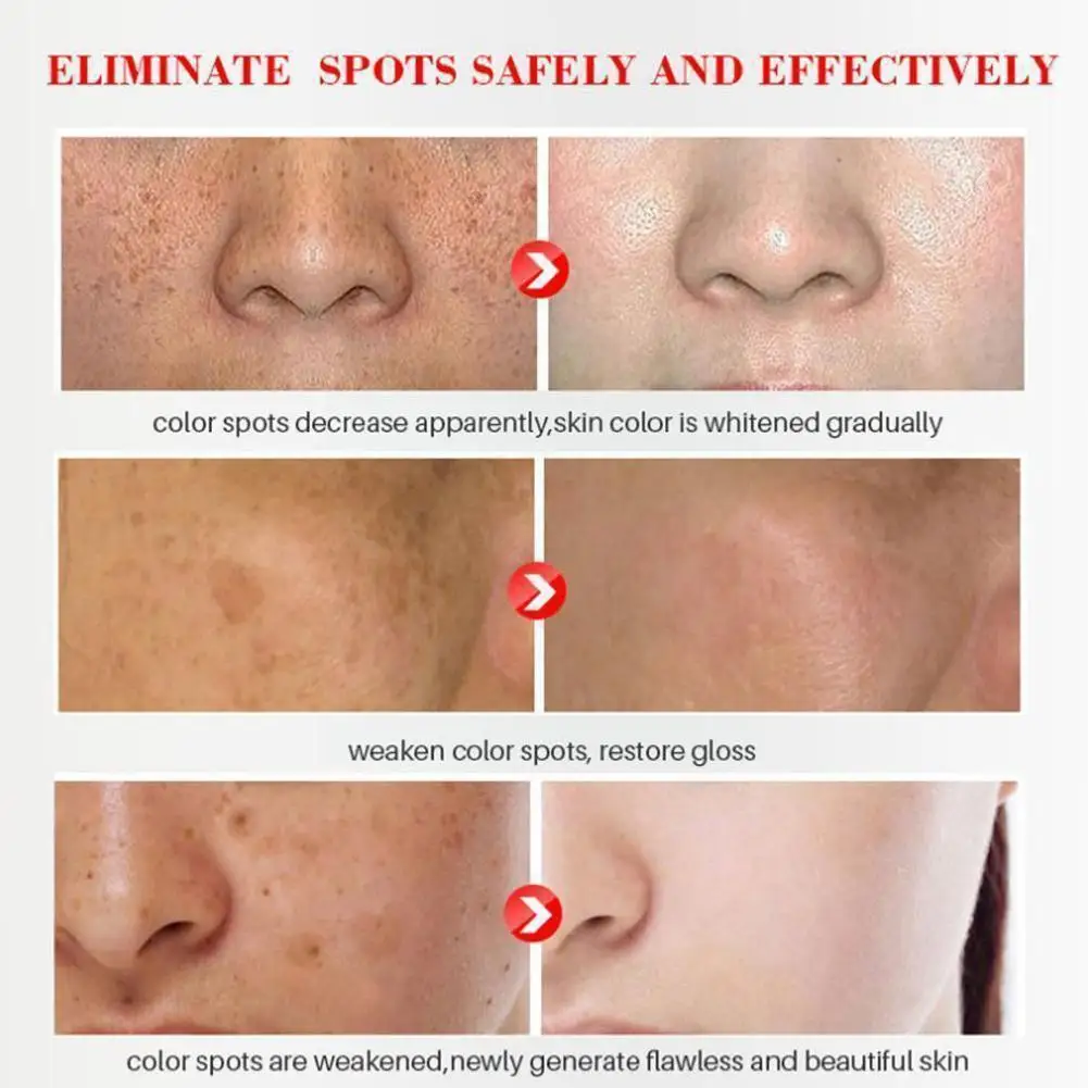 Effective Whitening Freckle Cream Remove Melasma Acne Melanin Moisturizing Pigmentation Dark Pigment Spot S V5k4 | Красота и здоровье