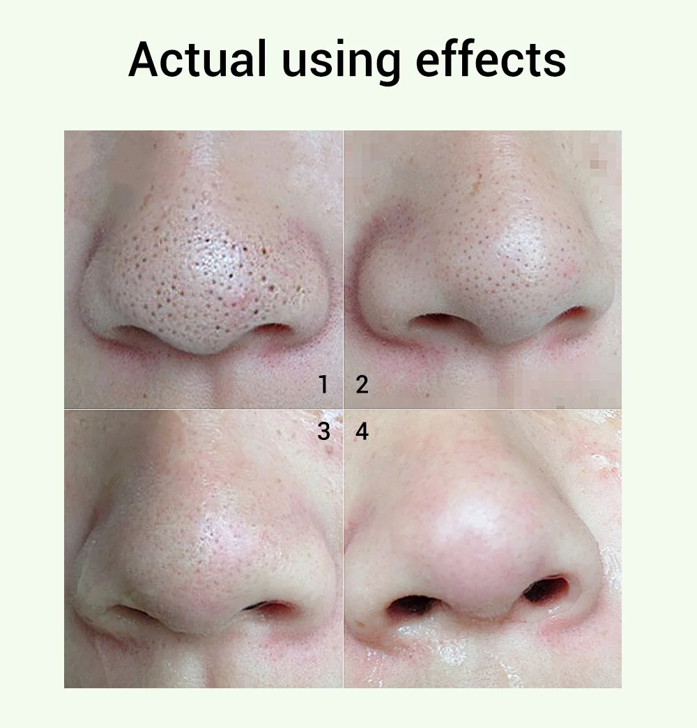 BREYLEE Tea Tree Black Head Nose Membrane Liquid and 100Pc Papers Blackhead Remover Acne Cleansing Peel Off Mud Mask 17ml |