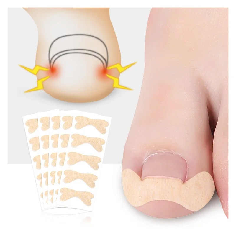 

6/12/30Pcs Ingrown Toenail Corrector Sticker Paronychia Treatment Fixer Recover Bunion Pedicure Feet Toe Nail Care Tool