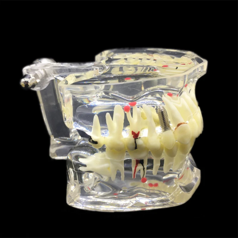 Стоматологическая прозрачная взрослая патологическая Модель дисплея зубов