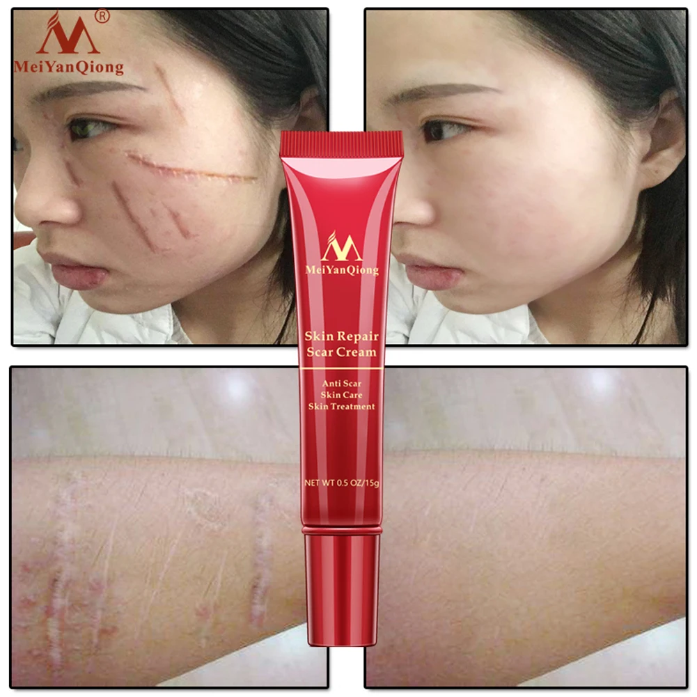 Крем для ухода за кожей гель лица Отпугиватель тела мягкое удаление шрамов