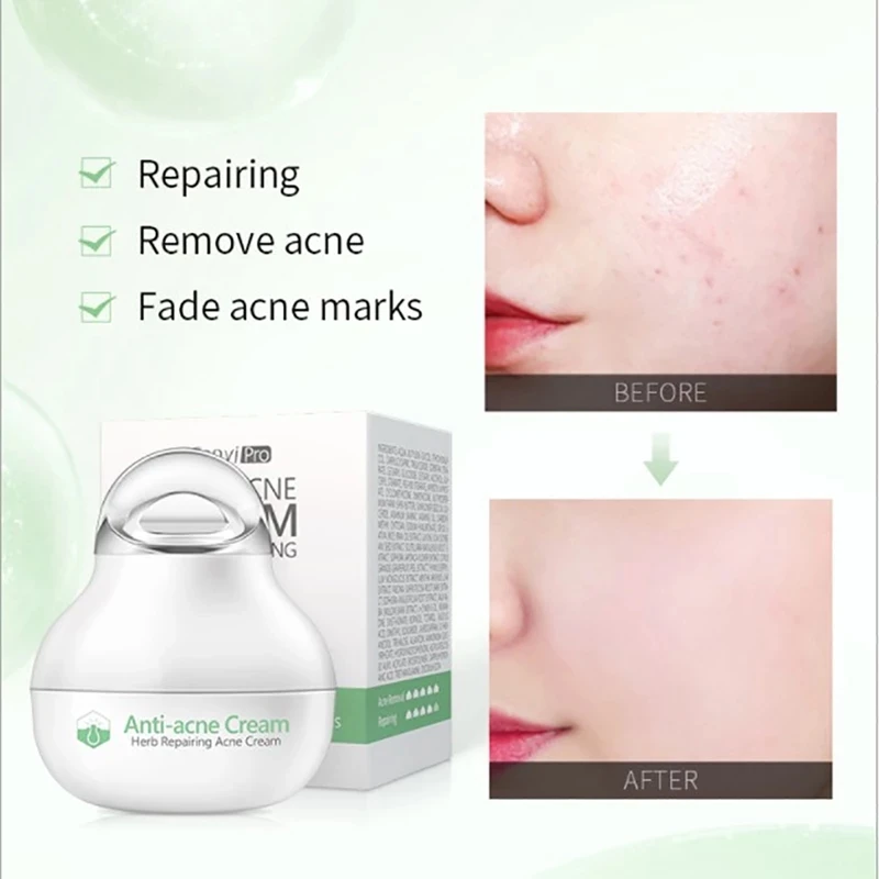 

Effective Anti-Acne Cream Acne Treatment Fade Acne Spots Oil Control Shrink Pores Whitening Moisturizing Acne Cream Skin Care